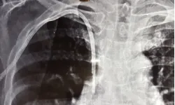 Chemoport